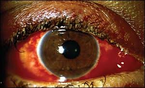 Persistent Eye Pain or Redness